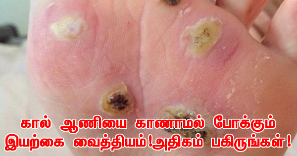 கால் ஆணியை காணாமல் போக்கும் இயற்கை வைத்தியம்!