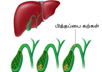 பித்தக்கற்களை இயற்கையாகவே கரைக்க?