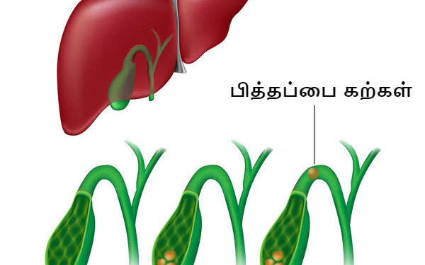 பித்தக்கற்களை இயற்கையாகவே கரைக்க?