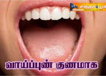 வாய்ப்புண் குணமாக?