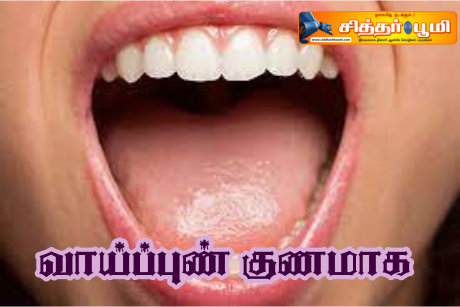 வாய்ப்புண் குணமாக?